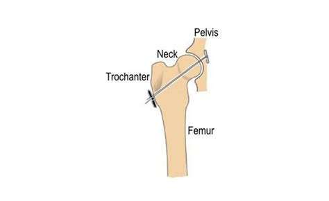 Coxofemoral (Hip) Luxation Dallas Veterinary Surgical …