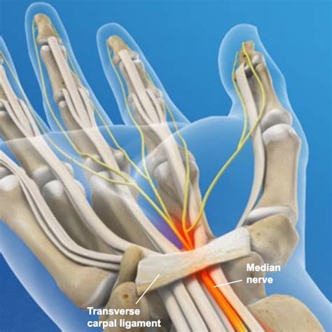 A standard carpal tunnel release was then performed by sharply in