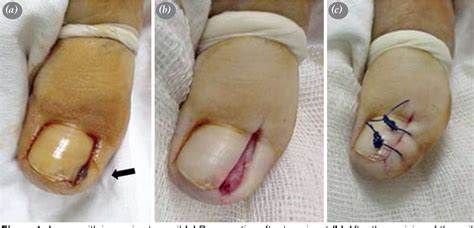 When a removal of either a medial or lateral border of a toenail is performed, CPT code 11730 (Avulsion of nail plate, partial or complete, simple; single) nor 11750 (Excision of nail and nail matrix, partial or complete (e.g., ingrown or deformed nail), for permanent removal) differentiate between a medial or lateral border avulsion.. 
