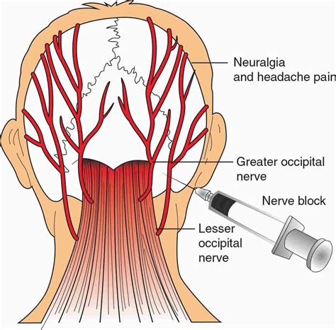  Blocks of the greater occipital nerve (GON) have