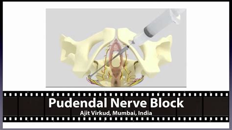 Treatments & Procedures / Pudendal Nerve Block Pudendal Nerve Block A pudendal nerve block is an injection in your pelvic region that can provide temporary pain relief. Healthcare providers use them for chronic pelvic pain and as regional anesthesia for certain procedures. The results can vary from person to person.. 