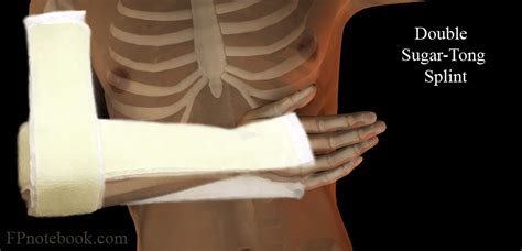 Aug 26, 2009 · Distal radius fractures traditionally require a sugar tong splint to prevent the patient from ranging the wrist and elbow. The sugar tong splint essentially sandwiches the forearm with a splint, folded at the elbow. At this elbow fold, however, the splint often uncomfortably and inconveniently buckles and wrinkles when a wrap is applied. Trick of the trade Reverse sugar tong splint A reverse ... . 