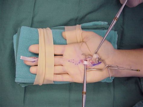  For hand surgery, regional anaesthetic is injected into the base of the neck or the top of the shoulder to numb the whole arm. If your tendon was damaged as the result of a wound, the wound will be thoroughly cleaned. A cut (incision) may be made in your hand to make the wound larger and the 2 ends of the ruptured tendon will be stitched together. . 