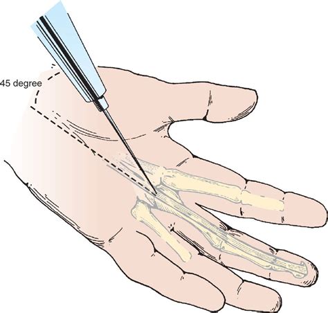 Identify the radial nerve laterally adjacent to the artery. 