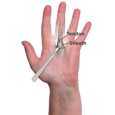 Tendon Sheath / Pulley procedure CPT Codes. ECU Subluxation codes. Laxity of ligament (728.4) Tendon sheath incision; at radial styloid eg, for deQuervains disease) (25000) Repair, tendon sheath, extensor, forearm and or wrist, with free graft includes graft harvest (25275) Tendon sheath incision eg, for trigger finger) (26055). 