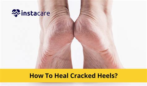 Crack in heel of foot hurts