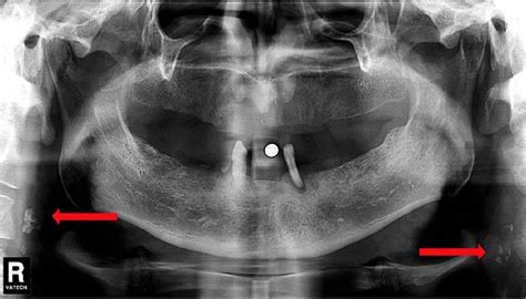 Cracking Carotid Calcification