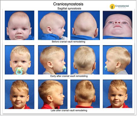 Craniosynostosis: Symptoms, Diagnosis, Treatment