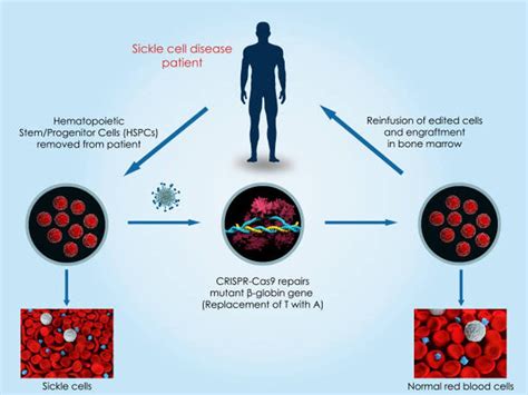CRISPR-Cas9 Gene Editing for Sickle Cell Dise