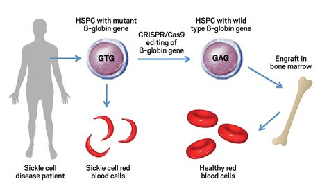 Crispr sickle cell anemia. Things To Know About Crispr sickle cell anemia. 