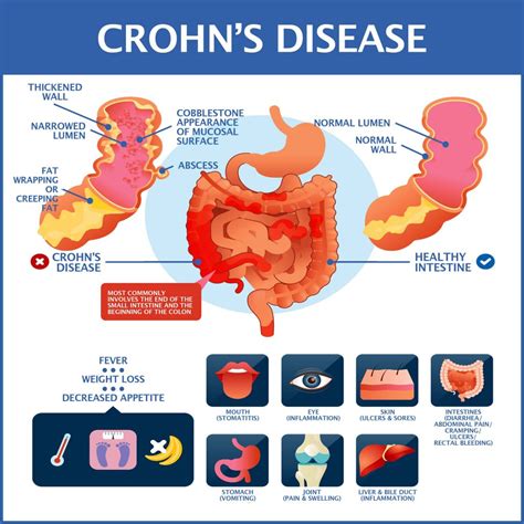 Crohn'S Disease 2022