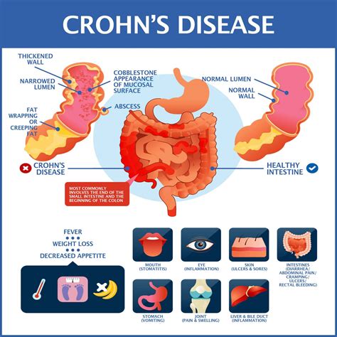 Crohn'S Disease 2023
