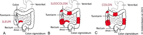 Crohns sjukdom – Wikipedia