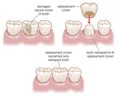 Crown Treatment Zocdoc