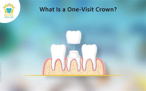 Crowns Single Visit near Topsham, ME WebMD