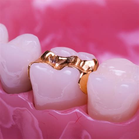 Most dental insurance plans provide the same benefits for same-day crowns as they do for traditional. And while each plan is different, a good ballpark coverage percentage for dental crowns is 50% to 80%. The best way to know what your specific benefits are is to talk to your dental team who can explain your insurance plan in detail.. 