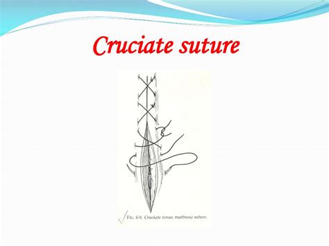 Cruciate Suture Pattern