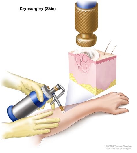 Cryoablation: Cryotherapy, Cryosurgery - Cleveland Clinic