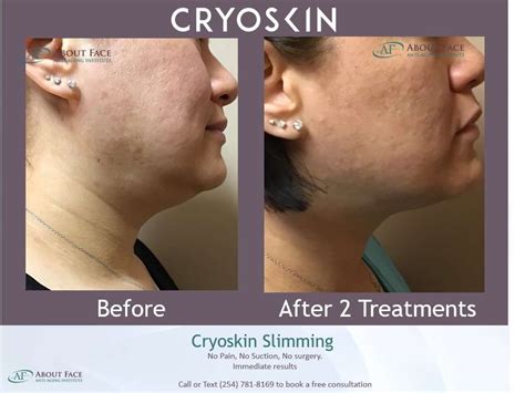 Cryoskin facial. A Cryoskin facial uses cool temperatures to widen the blood vessels, increasing blood flow. This increase in oxygen supply boosts collagen production, reduces the appearance of wrinkles and pores, and improves skin elasticity. A natural non-invasive way to look younger and more radiant. 