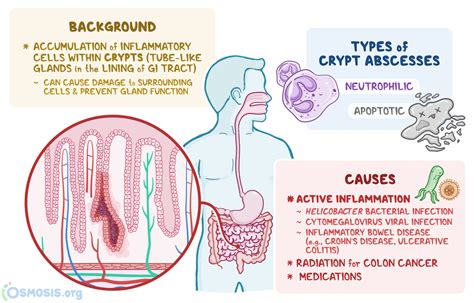 Crypt abscess in ulcerative colitis What it is causes and more