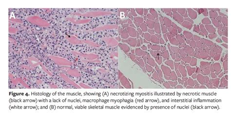 Cryptococcal Myositis and Vasculitis: An Unusual Necrotizing Soft ...