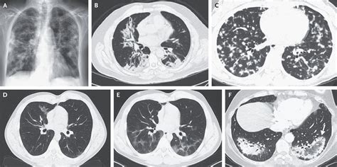 Cryptogenic organizing pneumonitis. The North American …