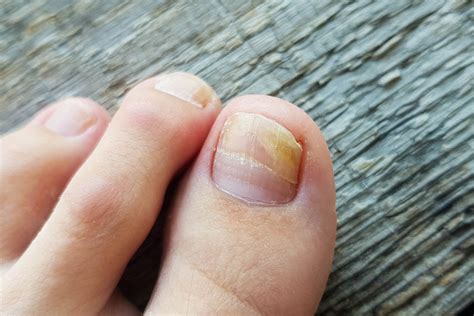 Crystal Podiatry Onychomycosis (Foot Fungus) in Spring Branch