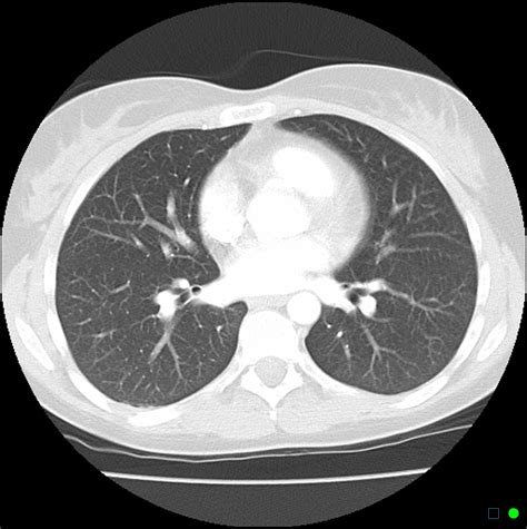 Ct scan thorax with contrast – Dane101