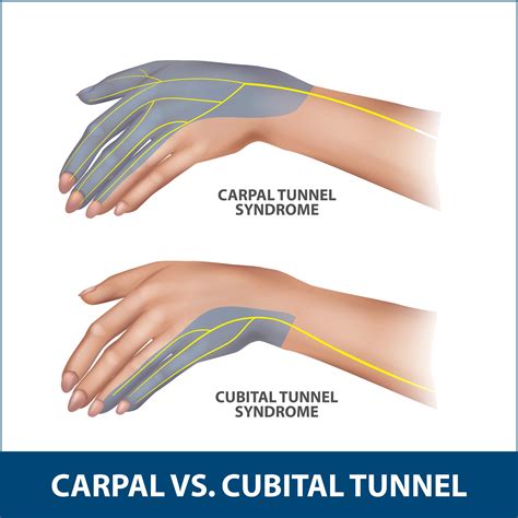 Cubital tunnel syndrome is what happens when the ulnar nerve becomes compressed inside the cubital tunnel. As it’s in a tight space, this is not an uncommon condition and the compression can happen quite easily. This can lead to similar symptoms are carpal tunnel: pain, weakness, and numbness and tingling.. 