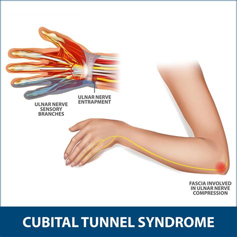 a ratio of 1.5:1, comparing the ulnar nerve area at the level of the cubital tunnel with that proximal to the cubital tunnel 9. 8.3 mm 2 cross-sectional area of the ulnar nerve at the epicondyle level 9. The ulnar nerve in patients with cubital tunnel syndrome is usually hypoechoic on ultrasound due to neural edema. MRI. 
