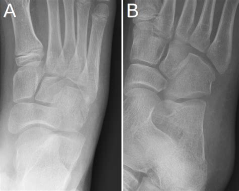 Cuboid Fracture Cuboid Bone Fracture Symptoms And Treatment Hot Sex