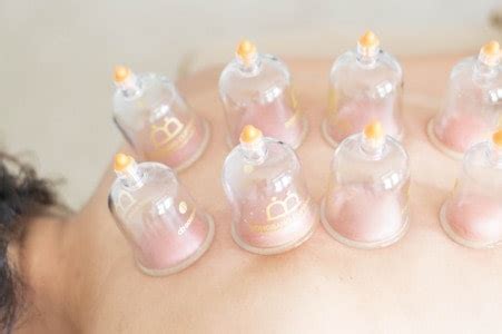 Cupping terapija - Alternativa za vas