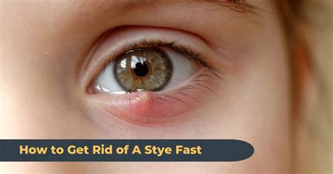 Cure for Styes - Get Rid of a Stye in 24 Hours or Less - Stye …