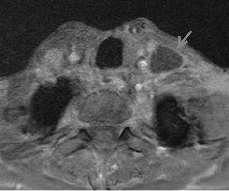 Cureus Chyloma: A Manifestation of Chyle Leak Six Months After …