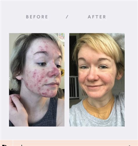 Curology reddit. Home. Beauty. Skin Care. Does Curology Work? I Tested the Personalized Skincare Brand & Here Are My Honest Thoughts. How my acne-prone skin fared after … 