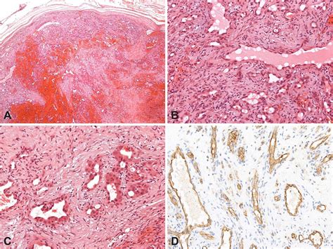 Cutaneous intravascular epithelioid hemangioma. A …