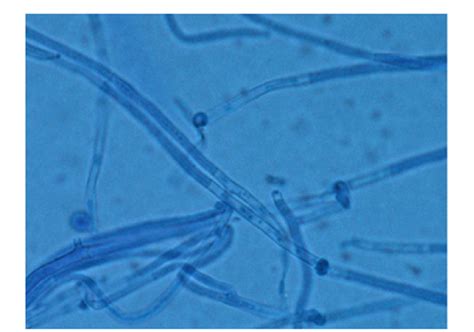 Cutaneous phaeohyphomycosis caused by Pyrenochaeta …