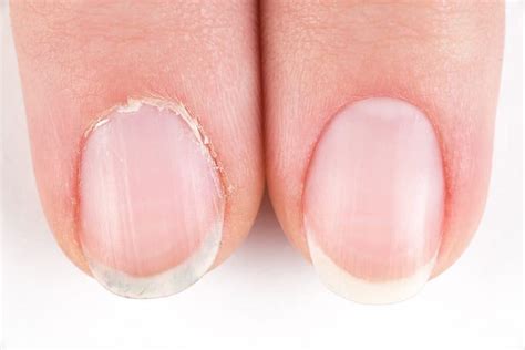 Cuticles nail. Keeping our nails and cuticles healthy is important not only for maintaining an attractive appearance, but also for protecting the skin beneath the nails. Our nails shield our fingers from all of the things our hands come in contact with each day and can help protect us from infection when they are properly cleaned and cared for. 