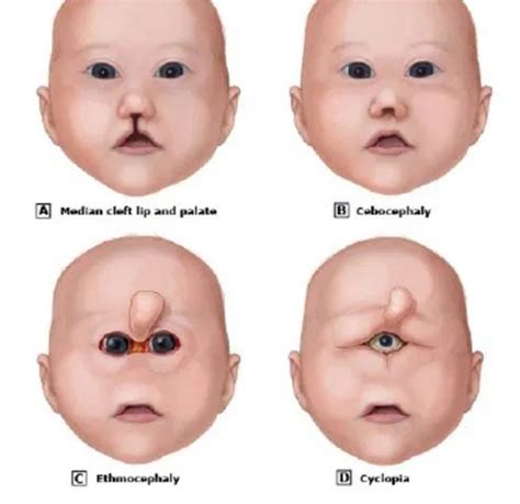 Cyclopia syndrome