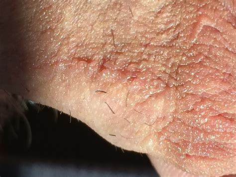  Vellus hair cysts usually present as small red or brown bumps over