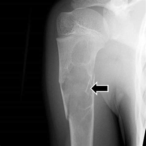 Cyst of bone: causes, symptoms, diagnosis, treatment - I Live! OK