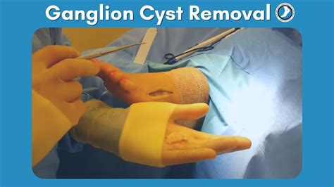 A cyst occurs when a lump of fluid forms within the dermis, the middle layer of skin. The majority of these free-floating lumps are benign. Infected cysts, t.... Cyst removal youtube
