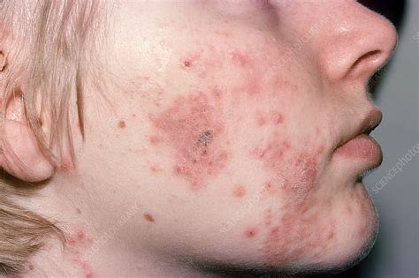 Cystic acne Stock Image C023/9330 Science Photo Library