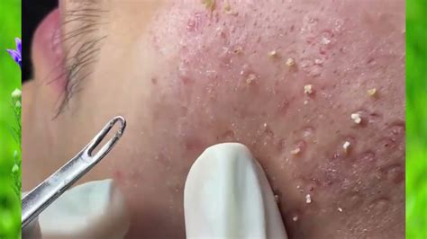 BEST Pimple Popping // Big Cystic Acne Bl