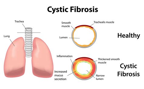 Full Download Cystic Fibrosis By Laurie A Whittaker