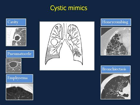 Cysts, blebs, bullae, cavities, honeycombing, …