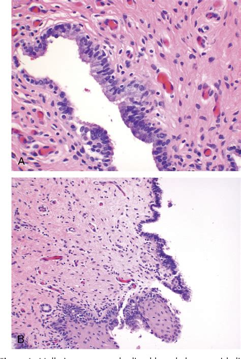 Cysts of the vagina in the newborn infant. Semantic Scholar