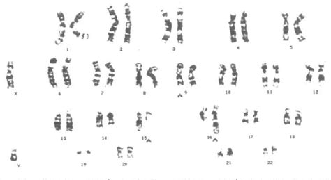 Cytogenetics of infertile men - PubMed