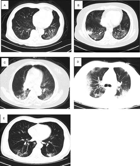 D-dimer surge and coagulation disorders in COVID-19 related ... - LWW