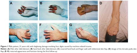 DEGLOVING INJURIES: PATTERNS, TREATMENT AND EARLY …